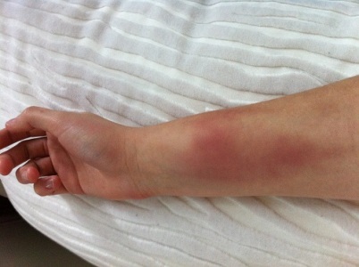 Krav Maga injuries: bruises after outside 360 defenses on arms