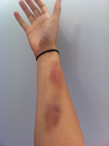 Krav Maga injuries: bruises after outside 360 defenses on arms